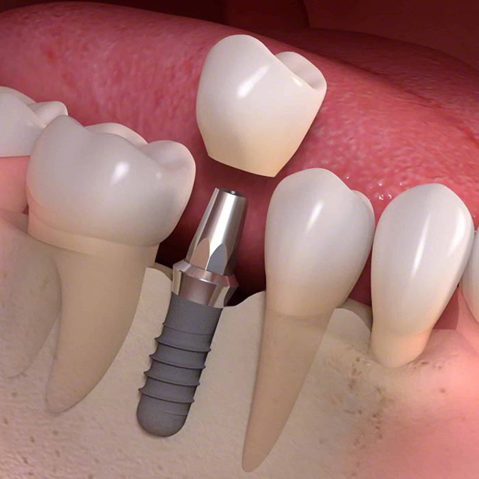 Single Tooth Implant